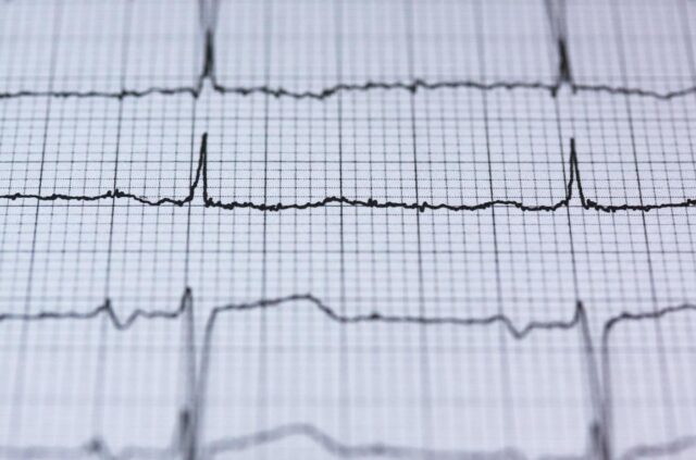 Tak Perlu ke Kota Besar, Kini Warga Kendal Bisa Cek Jantung Lewat Layanan EKG
